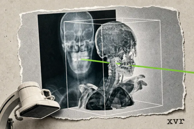 MIT Publishes Patient-Specific AI That Matches Surgical X-Rays in Seconds