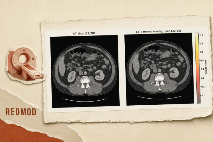 Mayo Clinic AI spotted pancreatic cancer signals over a year before diagnosis in study
